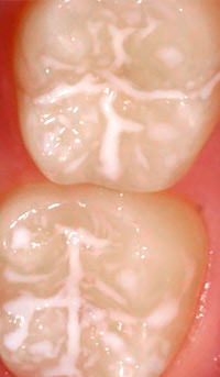 Fissurenversiegelung