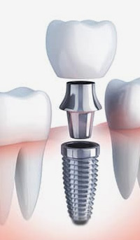Zahnimpant, Implantat