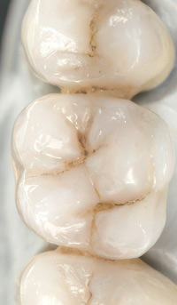 Vollkeramische Krone